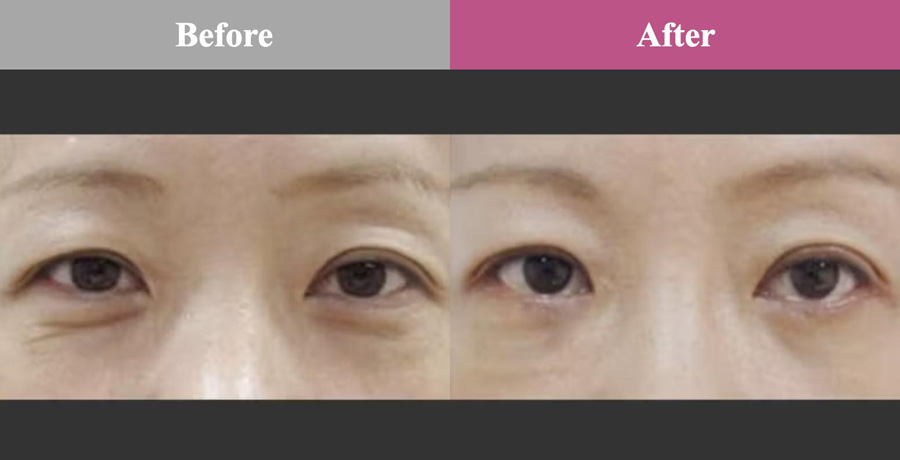 ボトックス治療比較画像